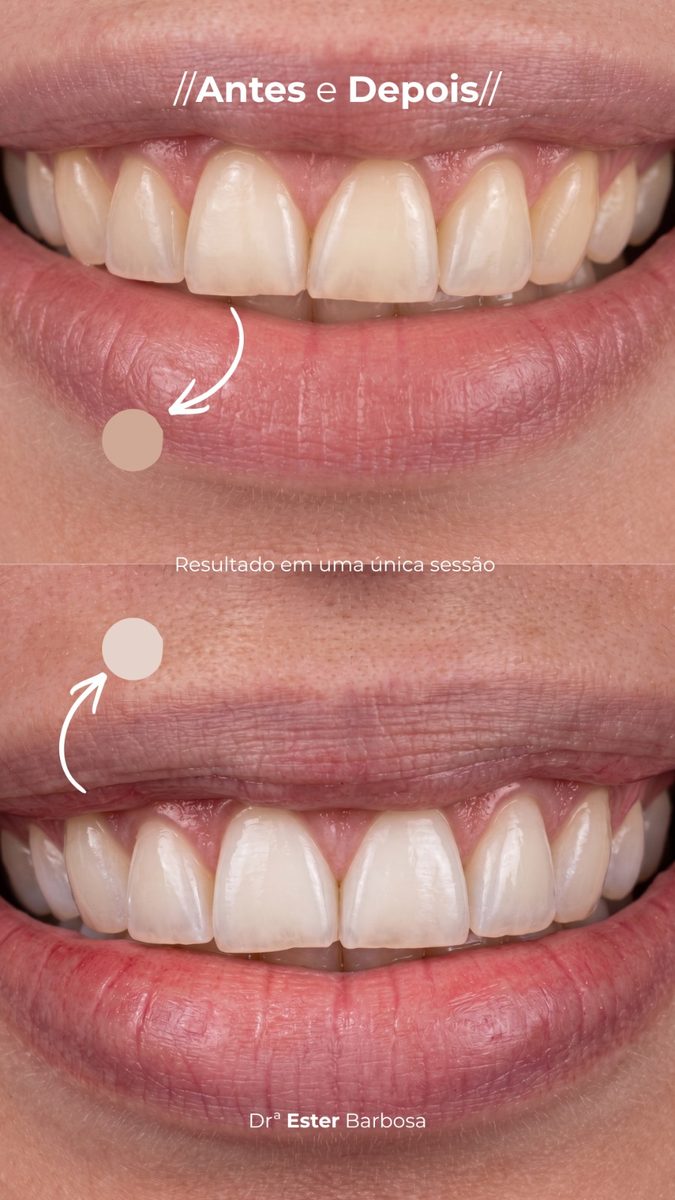 Antes e depois de clareamento dental