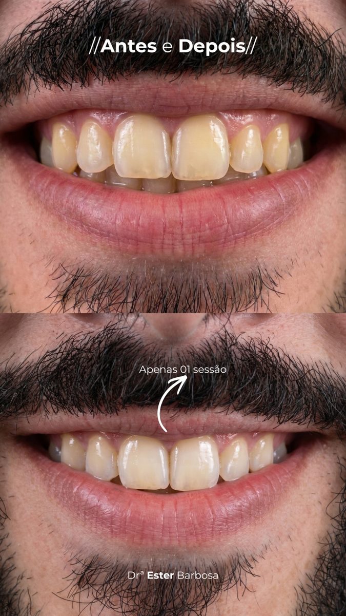 Antes e depois de clareamento dental masculino