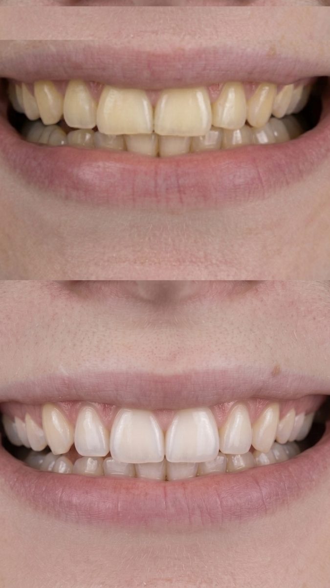 Antes e depois de clareamento dental, evolução de cor