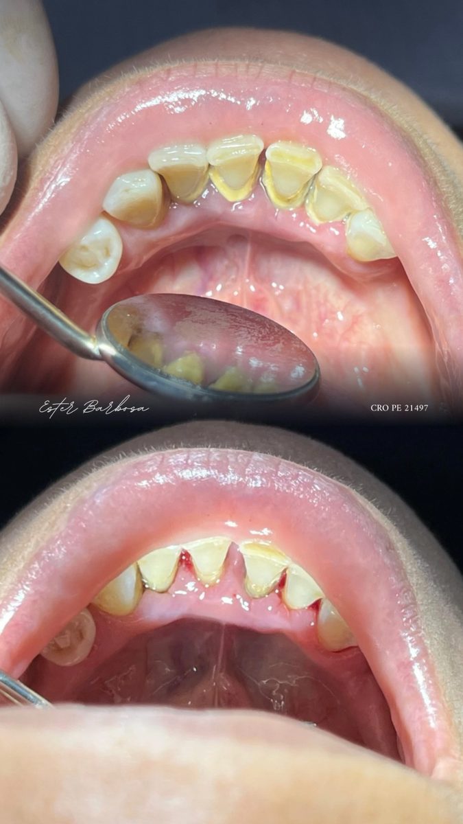 Antes e depois de limpeza e raspagem periodontal